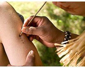 applying kambo queen of the forest jungle medicine sapo ceremony healing the tribe tree-frog